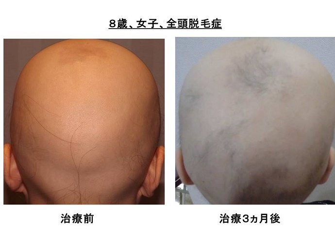 円形脱毛症　病院""